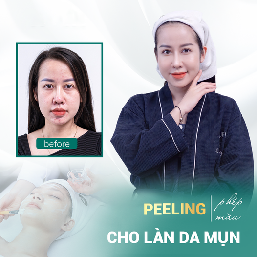 Peel Da Vi Tảo Retinol Có Tốt Không? Quy Trình - Địa Chỉ Uy Tín