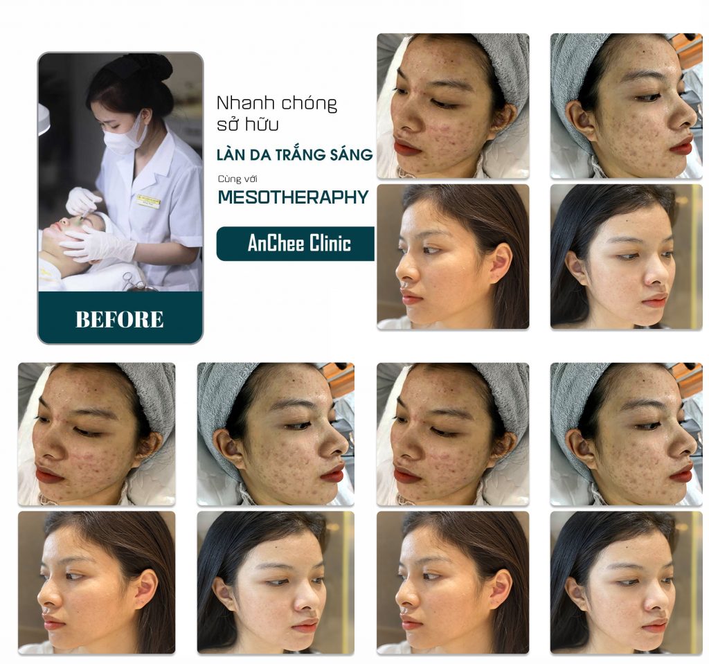 Top 12+ Spa Trị Mụn Quận 8 TPHCM: Hiệu Quả - Bảng Giá 2023
