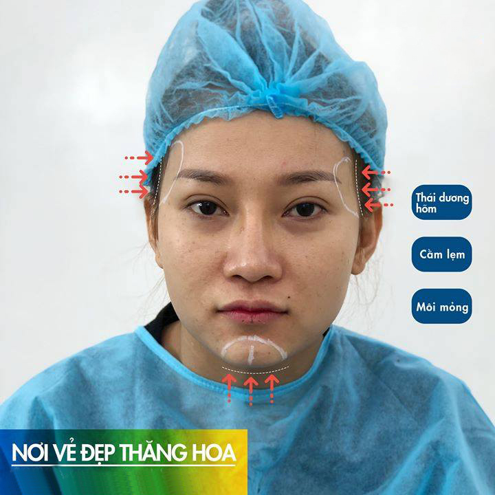 Tiêm Cằm Tròn Là Gì ? Có Tốt Không ? Giá Bao Nhiêu [2022]