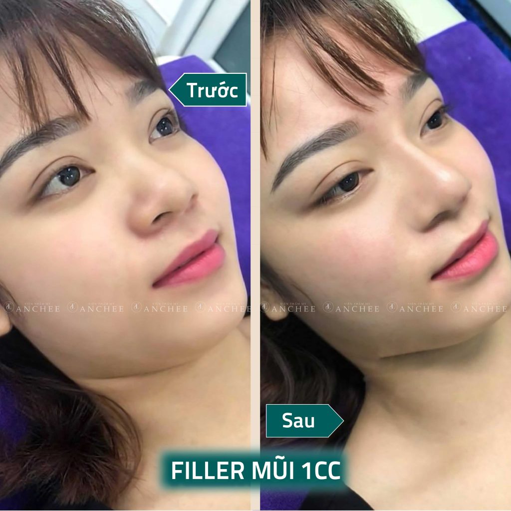 Giá Tiêm Filler Mũi Bao Nhiêu Tiền ? Hết Bao Nhiêu cc #2022