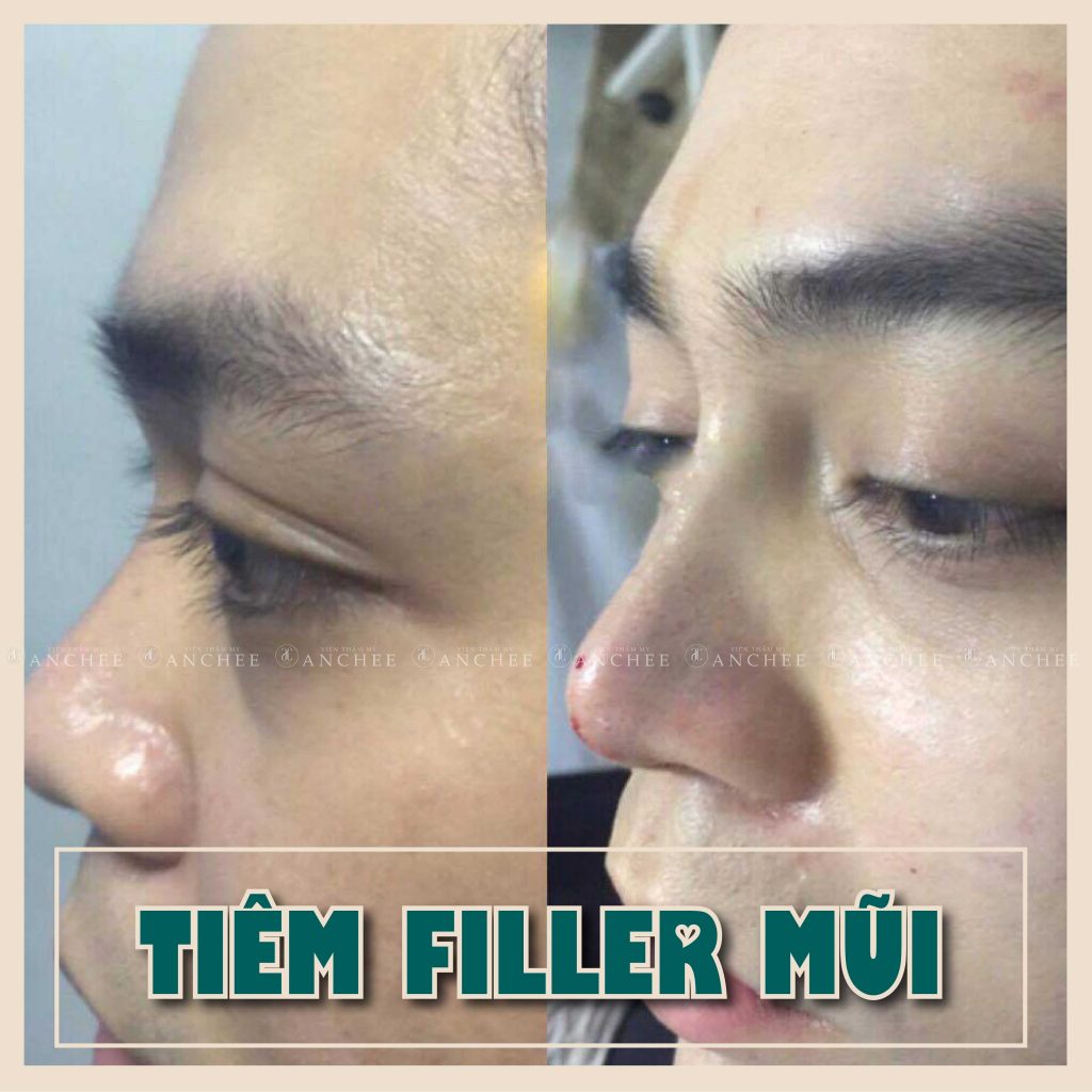 Giá Tiêm Filler Mũi Bao Nhiêu Tiền ? Hết Bao Nhiêu cc #2022
