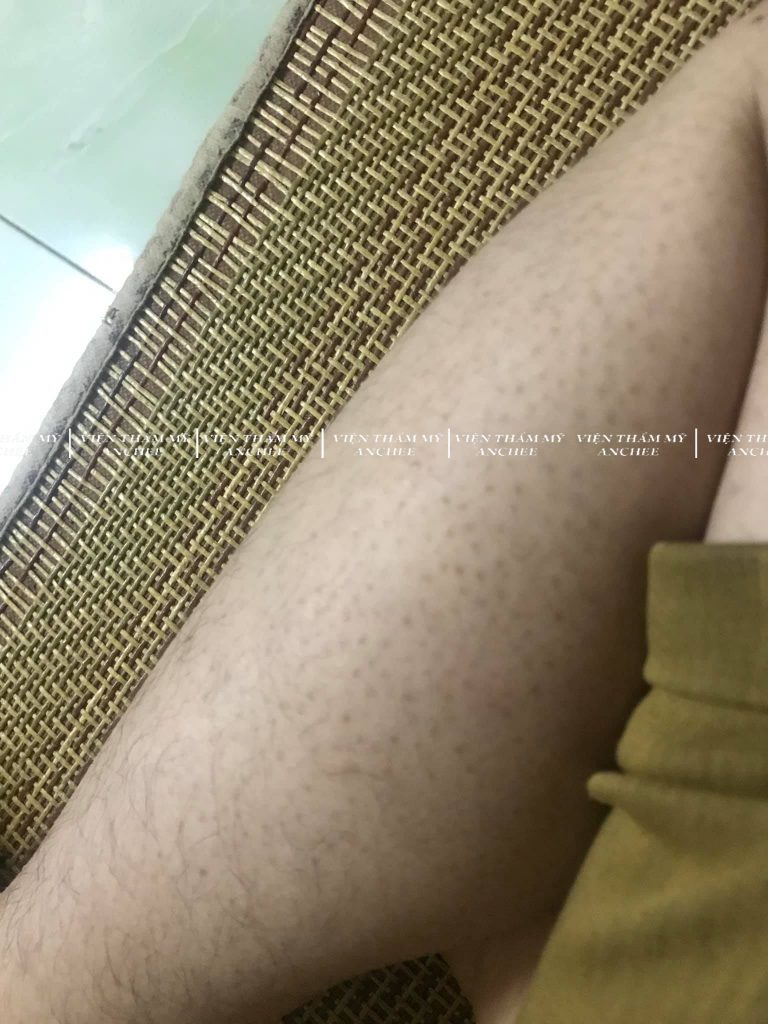 17+ Cách Trị Sẹo Thâm ở Chân Tại Nhà : Đơn Giản - Hiệu Quả