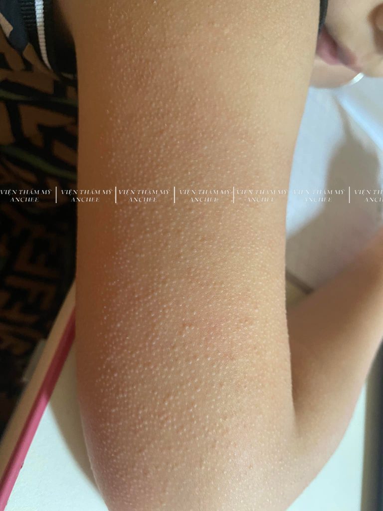 8+ Cách Trị Viêm Nang Lông ở Đùi hiệu quả sau 1 tuần 2023