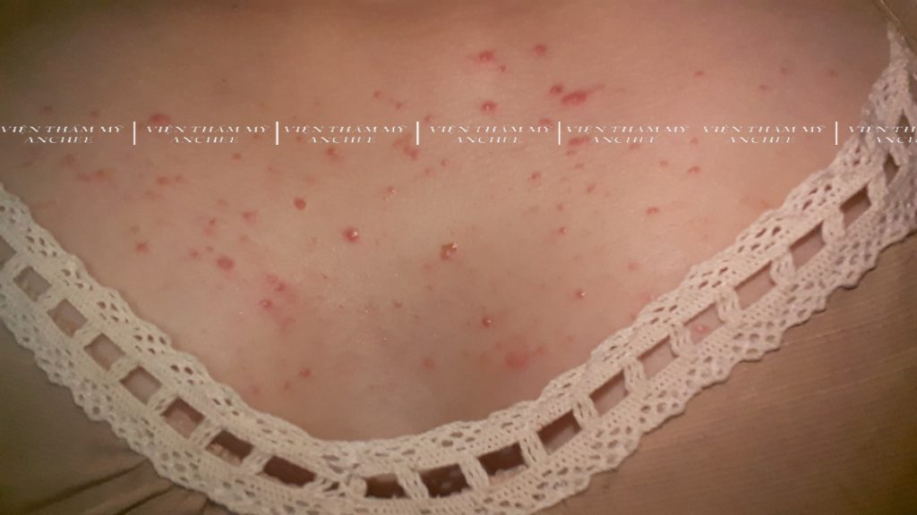 6+ Cách trị viêm nang lông ở ngực tại nhà hiệu quả nhất 2023