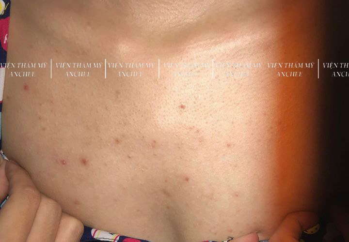 6+ Cách trị viêm nang lông ở ngực tại nhà hiệu quả nhất 2023