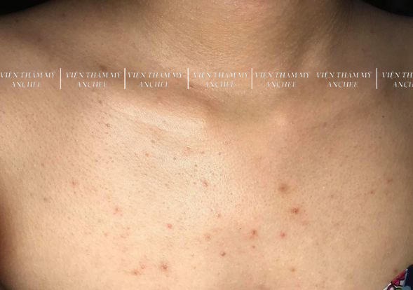 6+ Cách trị viêm nang lông ở ngực tại nhà hiệu quả nhất 2023