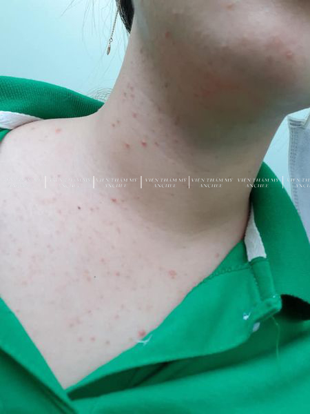 6+ Cách trị viêm nang lông ở ngực tại nhà hiệu quả nhất 2023