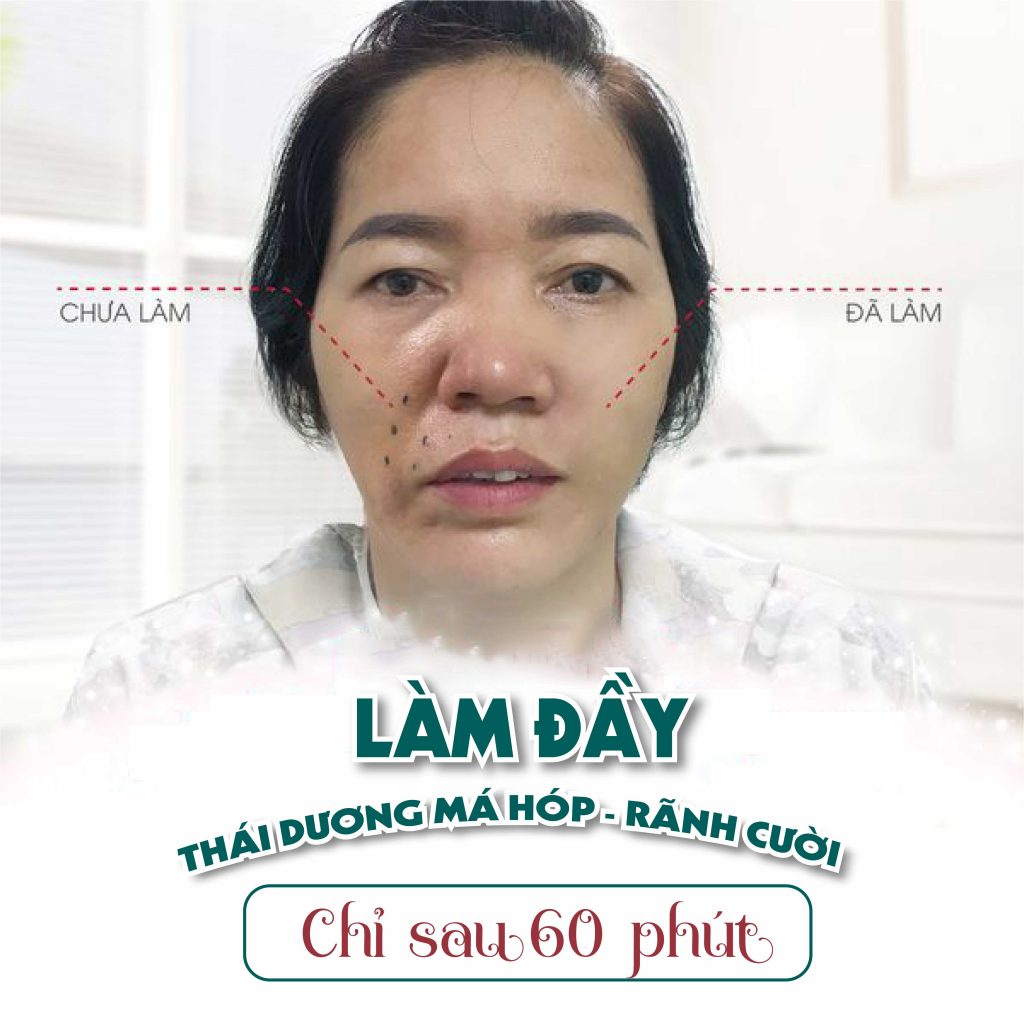 Tiêm Rãnh Cười Bị Đơ Có Nguy Hiểm Không? Chăm Sóc Rãnh Cười Sau Tiêm