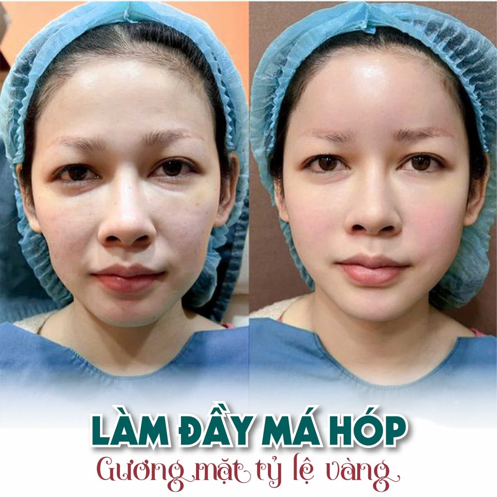 Tiêm Rãnh Cười Bị Đơ Có Nguy Hiểm Không? Chăm Sóc Rãnh Cười Sau Tiêm