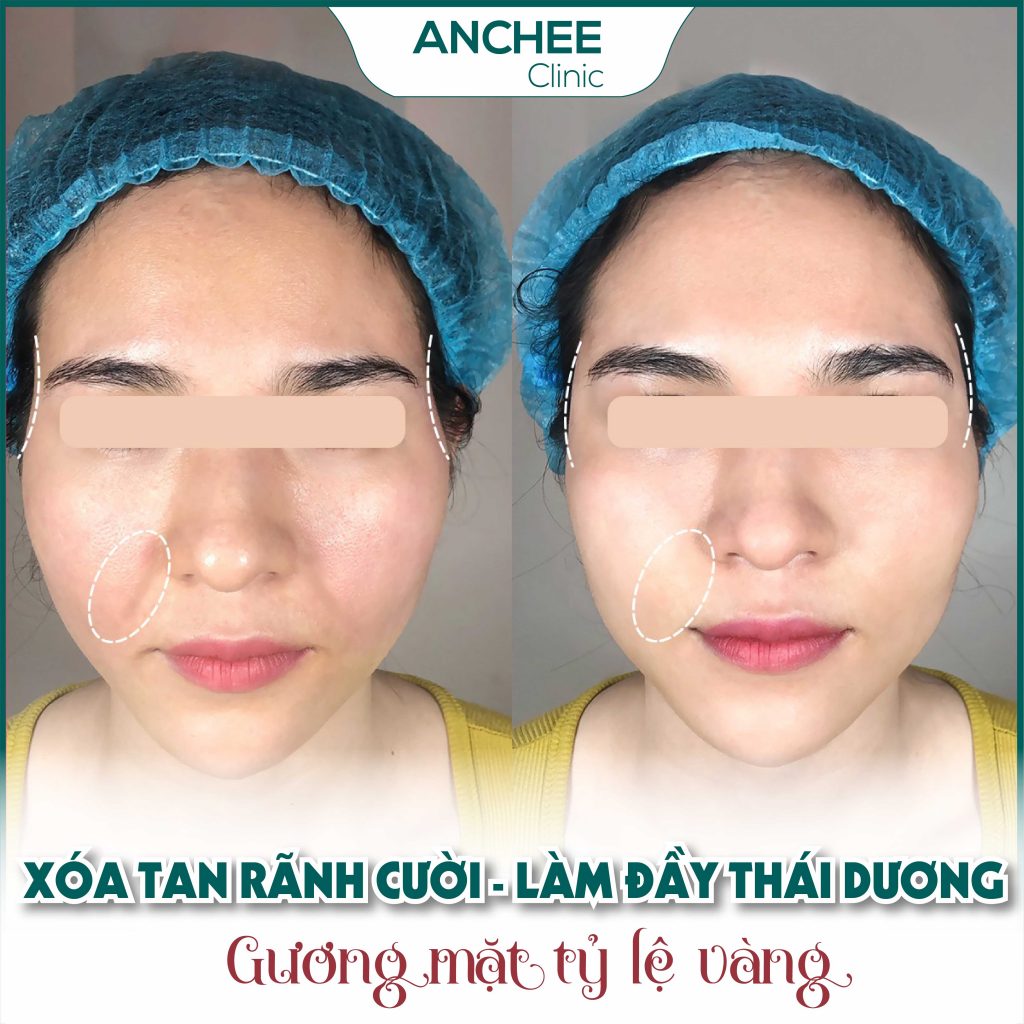 Tiêm Rãnh Cười Bị Đơ Có Nguy Hiểm Không? Chăm Sóc Rãnh Cười Sau Tiêm