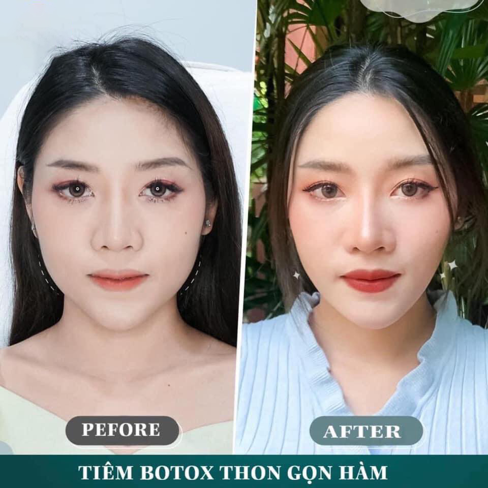 Tiêm Botox Gọn Hàm Giá Bao Nhiêu? Giữ Bao Lâu? Hình Sau Tiêm [2023]