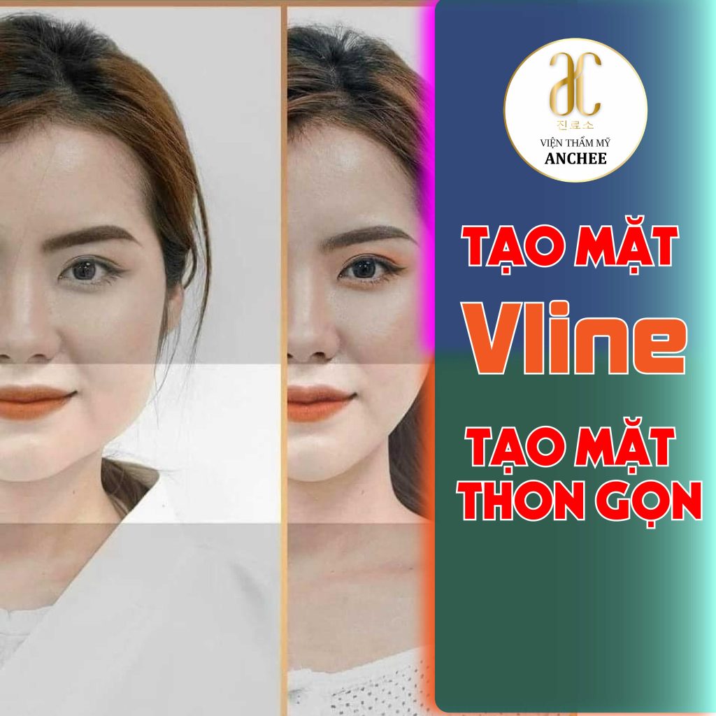 Review Tiêm Gọn Hàm Bằng Botox Chi Tiết Nhất Từ Khách Hàng