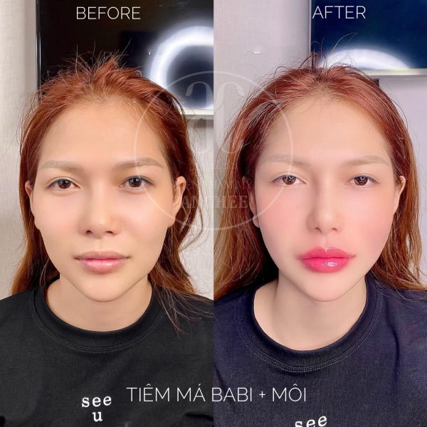 Tiêm Filler Môi Cherry Là Gì Top 6 Dáng Môi Đẹp Sexy Nhất 2023 