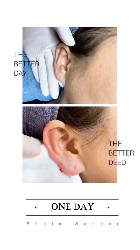 Filler Tiêm Tai Tài Lộc Giá Bao Nhiêu ? Giữ Bao Lâu ?[2022]