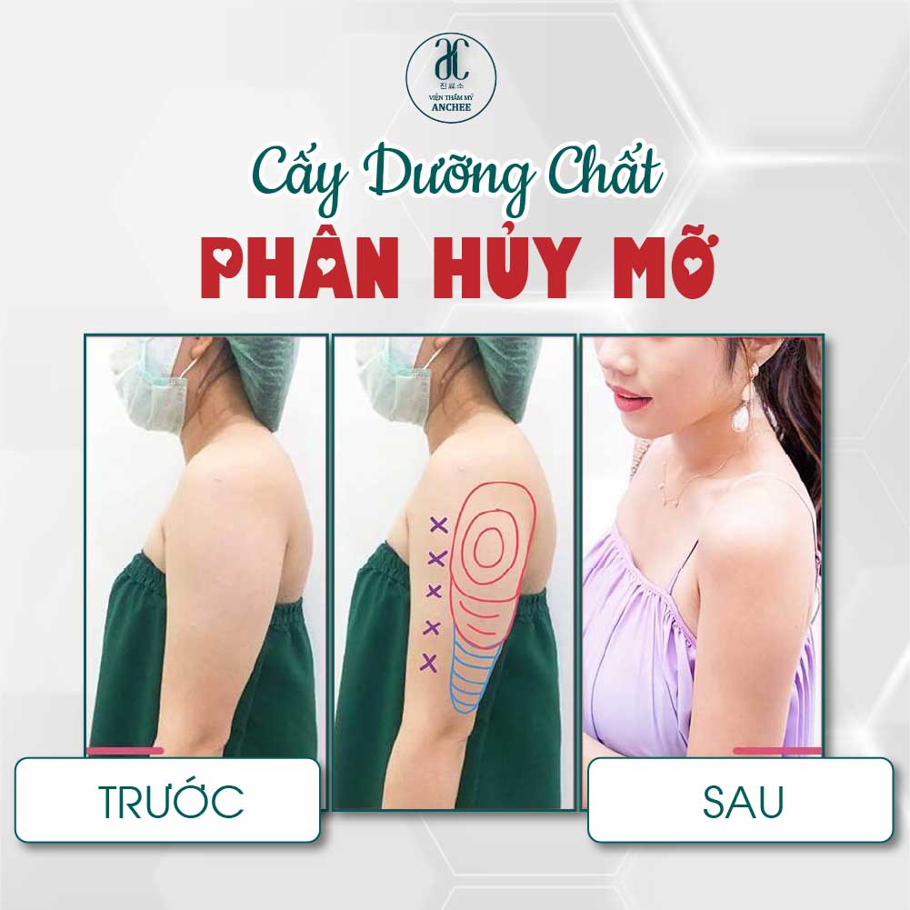 Tiêm tan mỡ bắp tay giá bao nhiêu? Giảm bao nhiêu cm? 2022