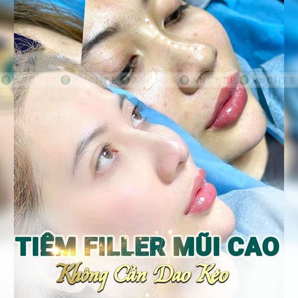 Giá Tiêm Filler Mũi Bao Nhiêu Tiền ? Hết Bao Nhiêu cc #2022