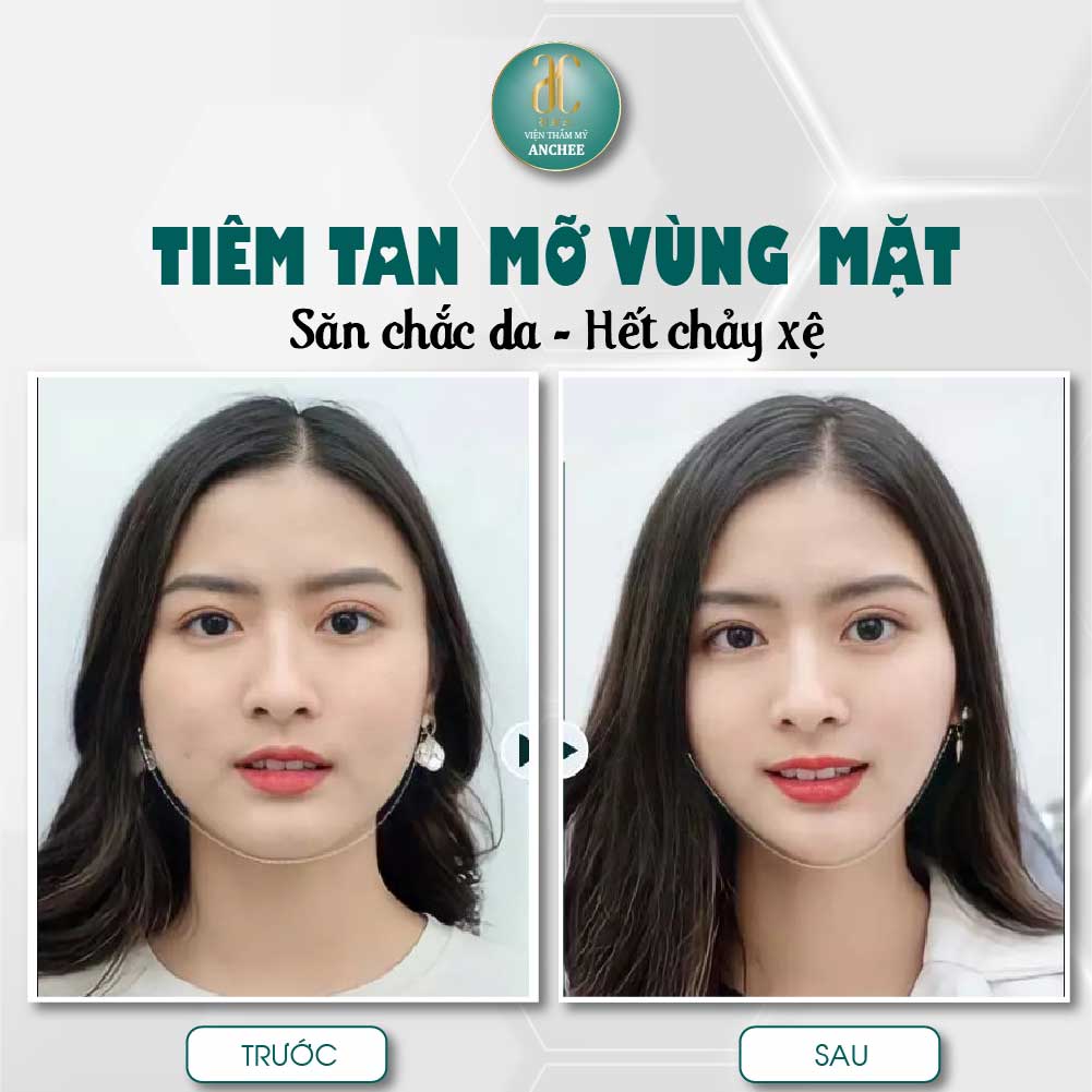 Tiêm tan mỡ nọng cằm giá bao nhiêu ? Có hết mỡ không #2022