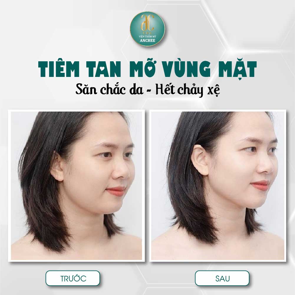 Tiêm tan mỡ nọng cằm giá bao nhiêu ? Có hết mỡ không #2022