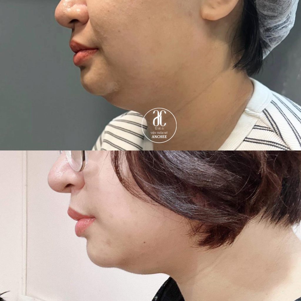 tiêm tan mỡ nọng cằm