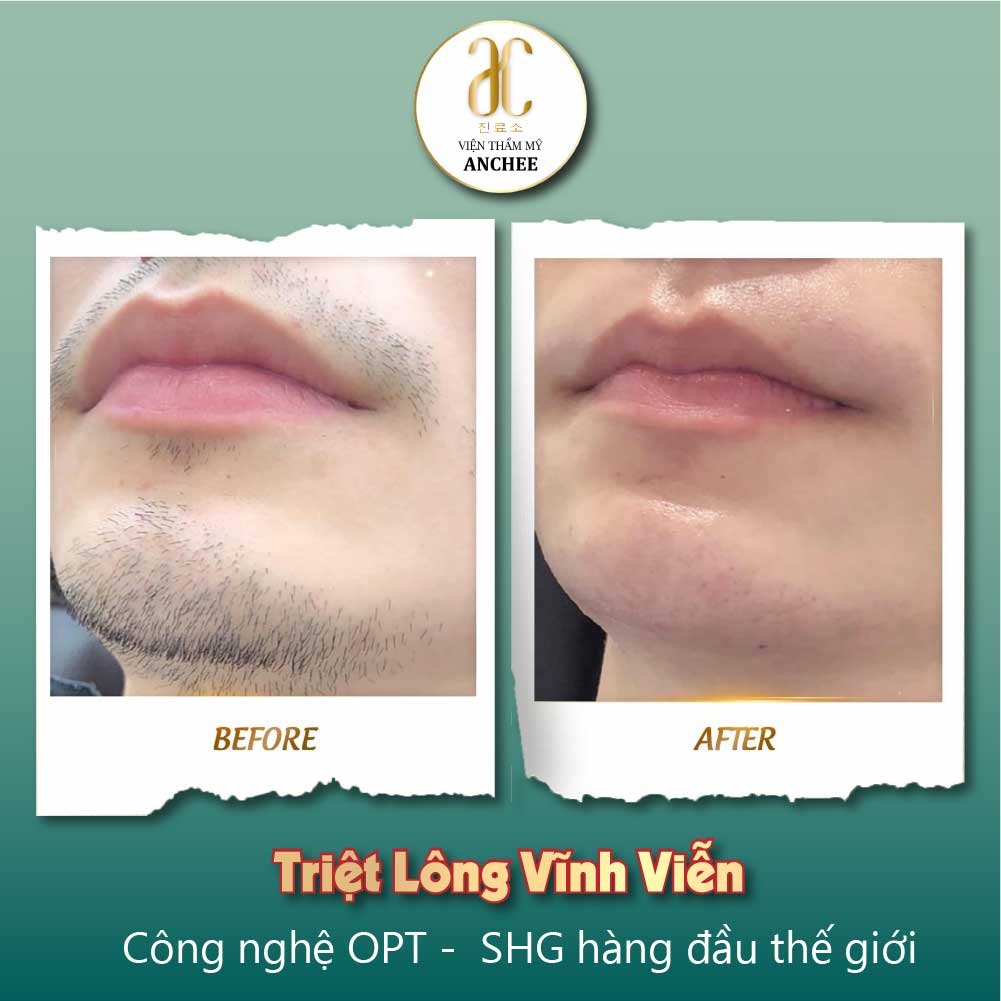 Triệt lông cho Nam Giới bảo hành trọn đời :Giá Rẻ Nhất 2022