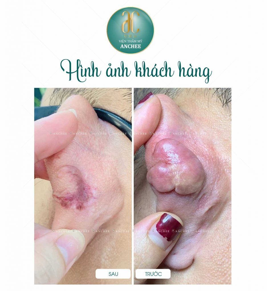 Tiêm sẹo lồi bao nhiêu tiền? Có hết không? Bao lâu xẹp? 2022