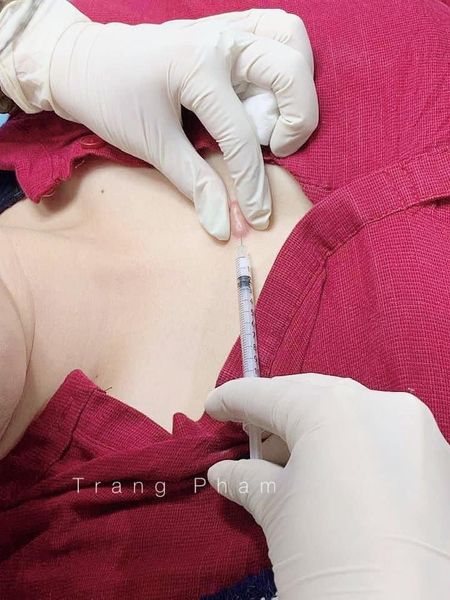 Tiêm sẹo lồi bao nhiêu tiền? Có hết không? Bao lâu xẹp? 2022