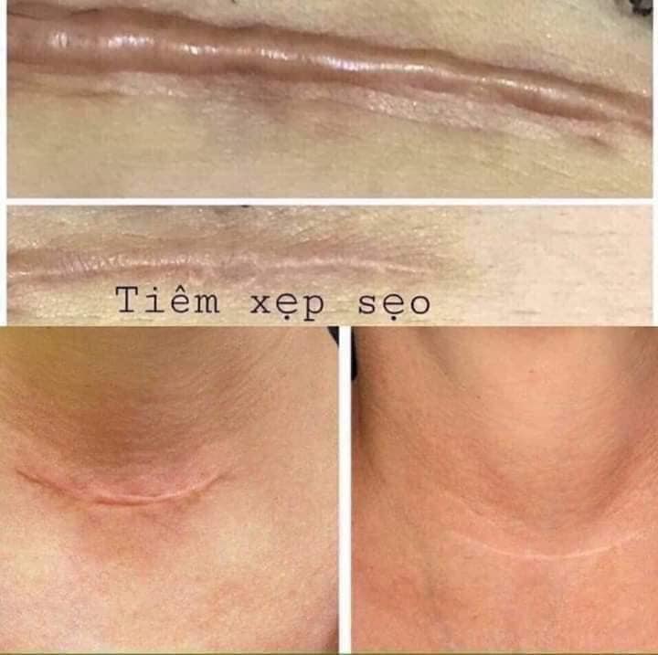 Tiêm sẹo lồi bao nhiêu tiền? Có hết không? Bao lâu xẹp? 2022