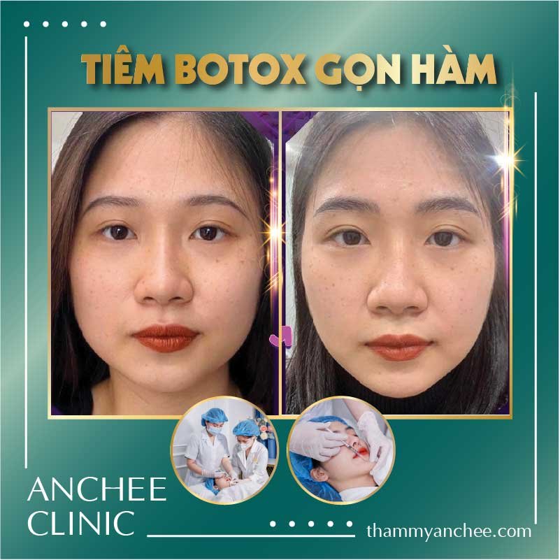 Tiêm Botox Gọn Hàm Giá Bao Nhiêu? Giữ Bao Lâu? Hình Sau Tiêm [2023]