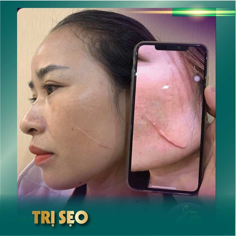 20 Thẩm mỹ viện trị sẹo rỗ uy tín, an toàn và tốt nhất tại TPHCM