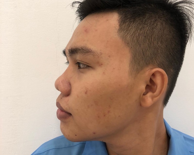 Mũi Tẹt Là Như Nào ? Vận Mệnh Tướng Số Mũi Tẹt Ra Sao ?