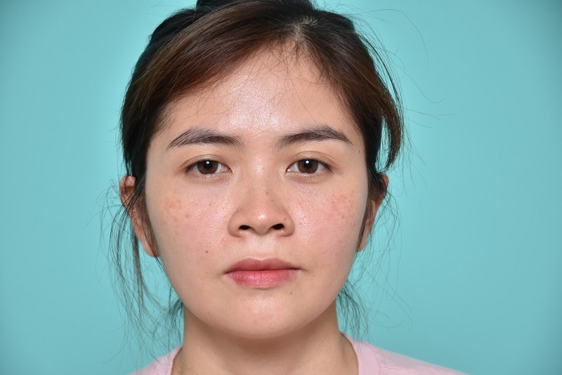 Mũi Tẹt Là Như Nào ? Vận Mệnh Tướng Số Mũi Tẹt Ra Sao ?