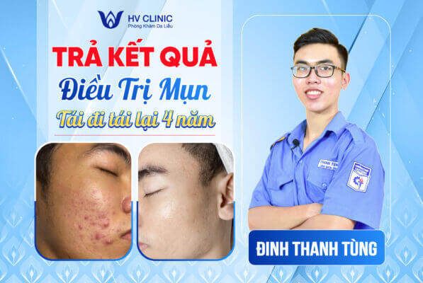 Top 13 Spa Trị Nám Tàn Nhang tại Tphcm : Cam Kết Hiệu Quả