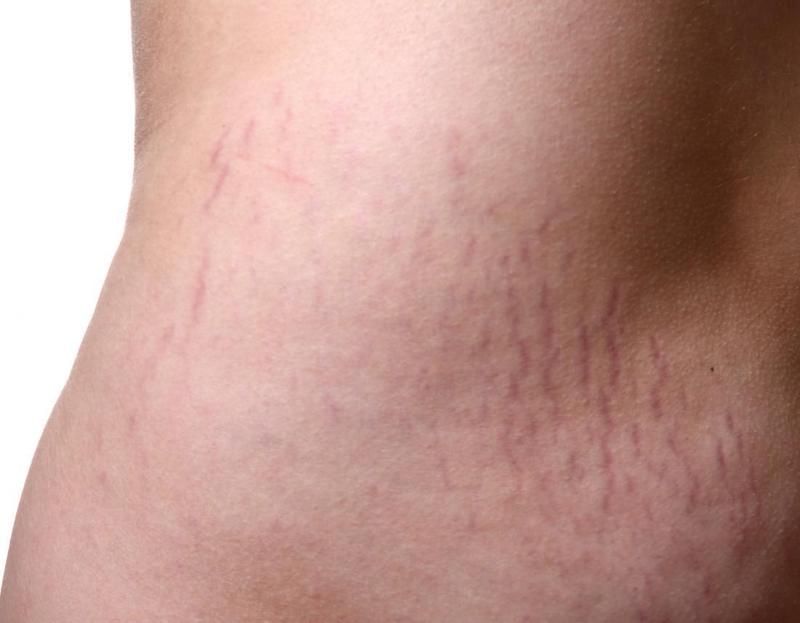 Nguyên nhân bị rạn da màu đỏ – Những cách trị rạn da nhanh, hiệu quả nhất