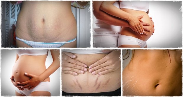 Nguyên nhân bị rạn da màu đỏ – Những cách trị rạn da nhanh, hiệu quả nhất