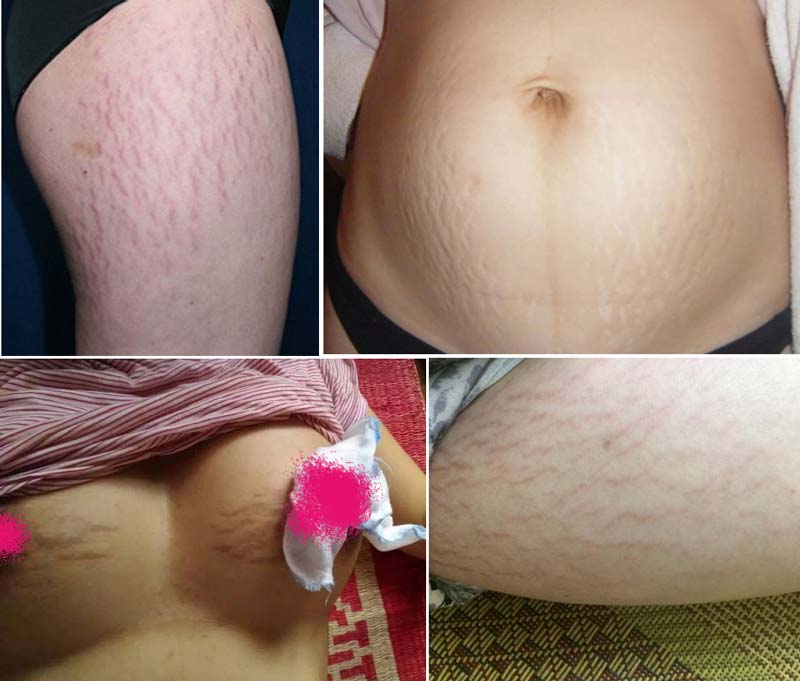 Tổng hợp nguyên nhân và cách trị rạn da tốt nhất hiện nay