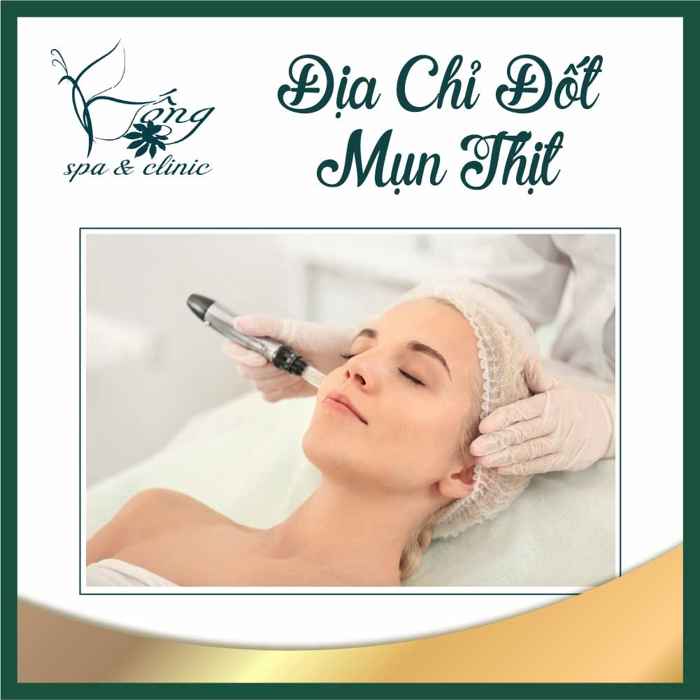 TOP 20+ Địa Chỉ Đốt Mụn Thịt Uy Tín ở TPHCM chỉ từ 50k/Nốt