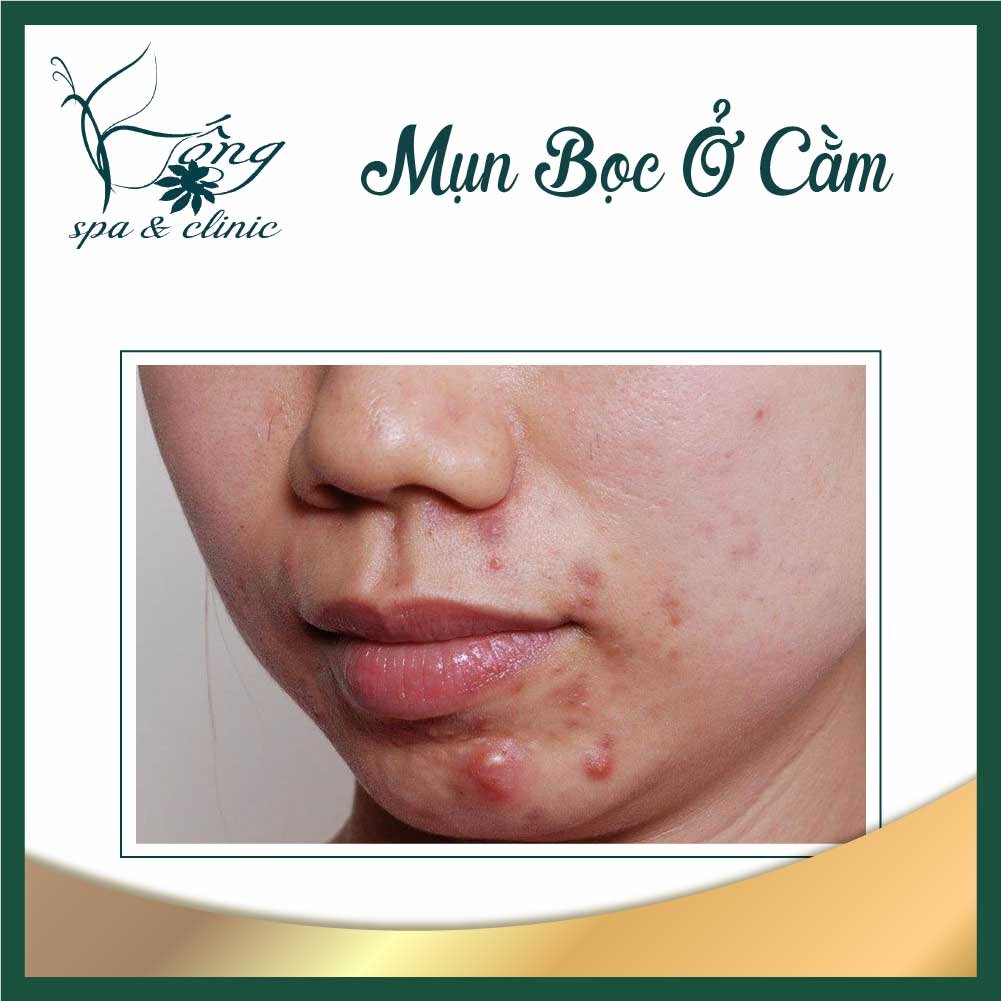 Mụn bọc ở cằm có nên nặn? Nguyên nhân & 5 cách trị mụn bọc