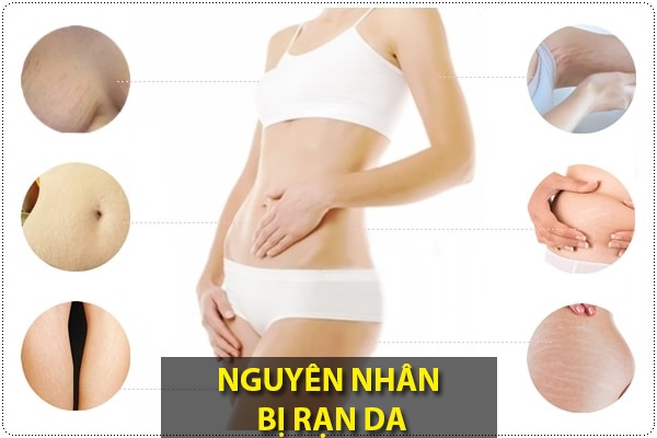 Tổng hợp nguyên nhân và cách trị rạn da tốt nhất hiện nay