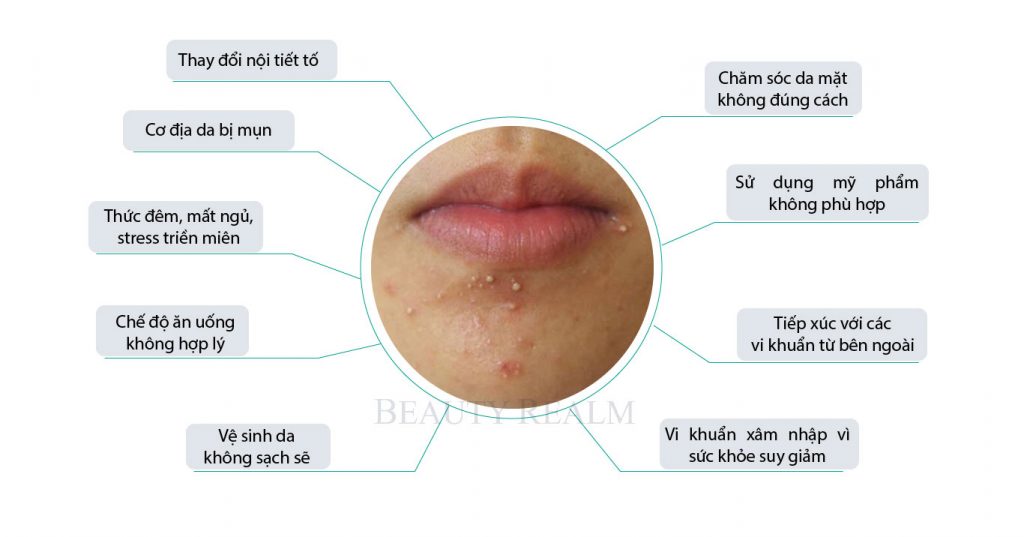 Mụn bọc ở cằm có nên nặn? Nguyên nhân & 5 cách trị mụn bọc