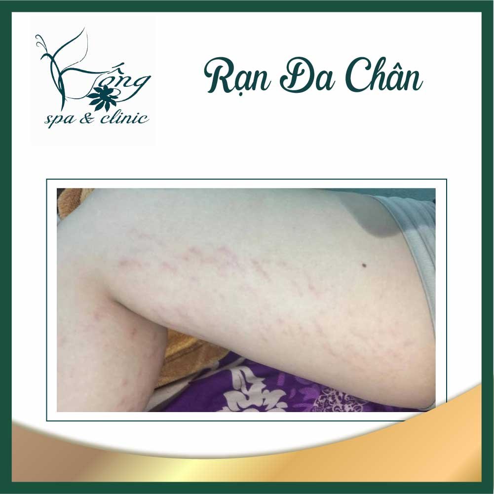 Top 10+ Bí quyết "Trị Rạn Da Chân" hiệu quả nhanh , mờ sạch