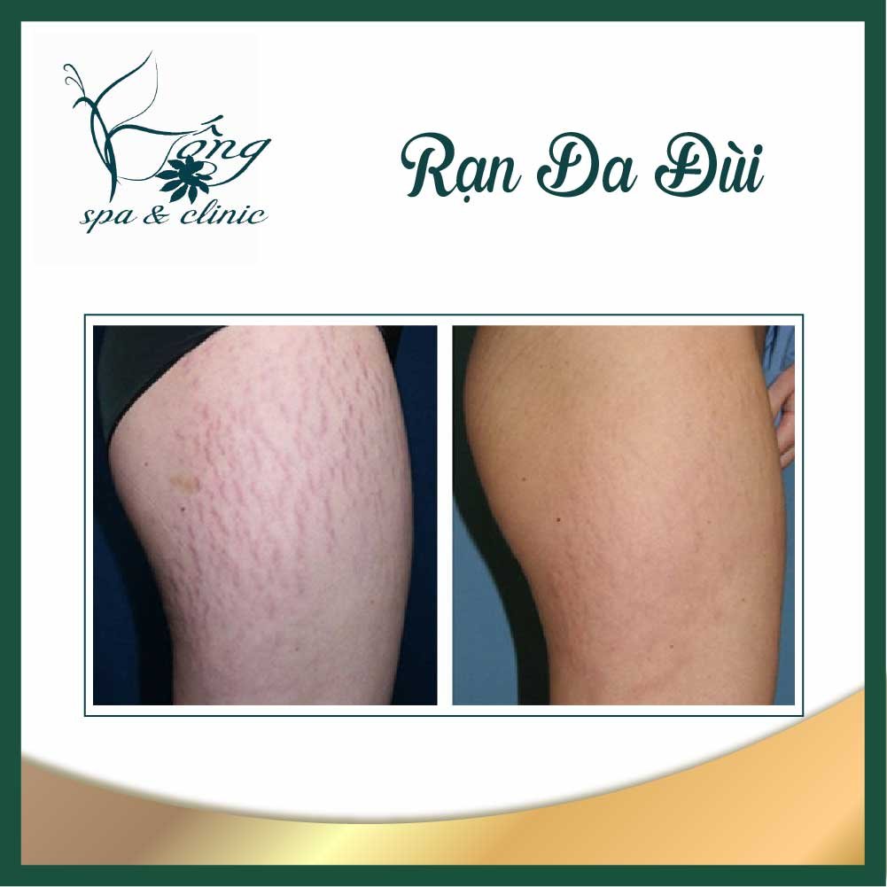 Rạn da đùi - 5 Nguyên nhân và 6 cách khắc phục hiệu quả nhất