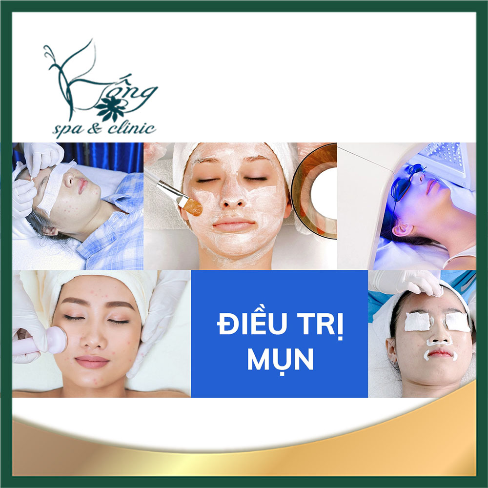 trị mụn miễn phí