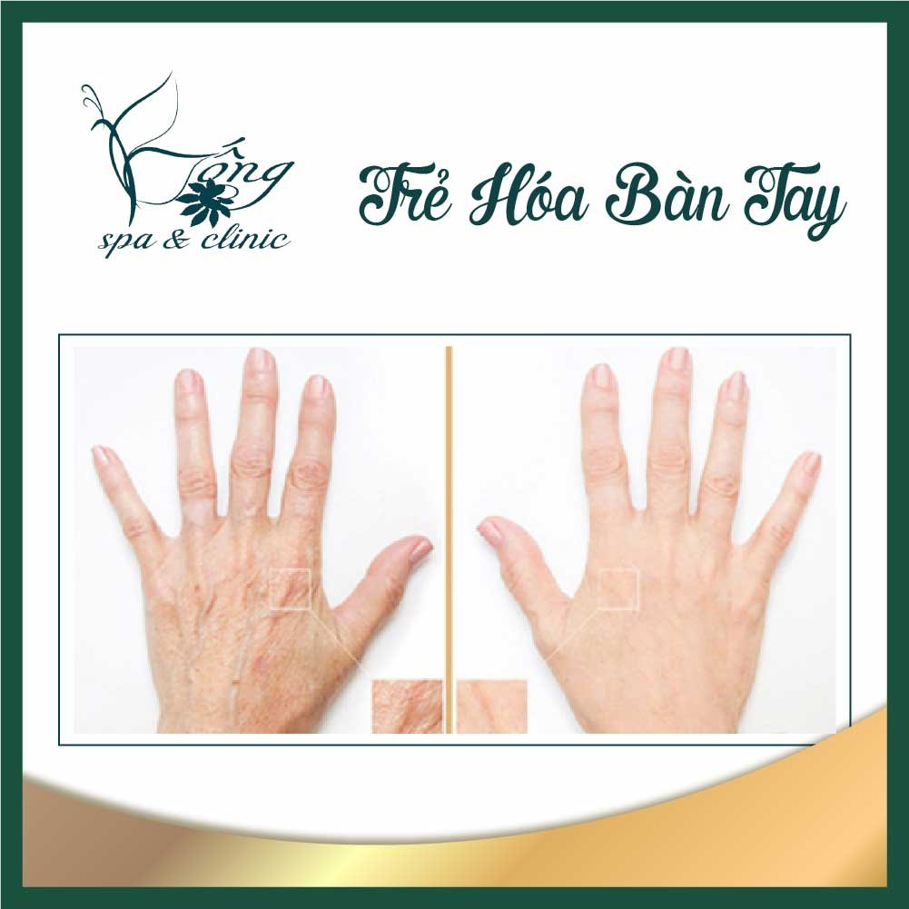 Trẻ hoá bàn tay - Phương pháp thẩm mỹ để có đôi tay thật dịu dàng