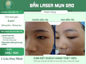 cách trị mụn gạo ở mắt