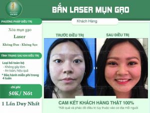 cách trị mụn gạo ở mắt