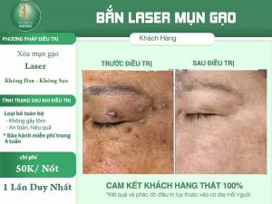 cách trị mụn gạo ở mắt