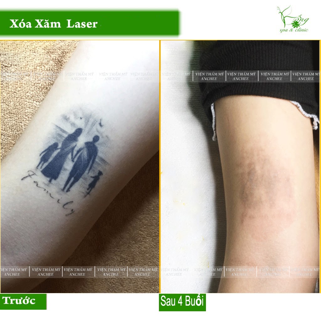 Xoá Xăm Không Sẹo Bằng Laser Có Ưu Điểm Gì? Quy Trình Thực Hiện