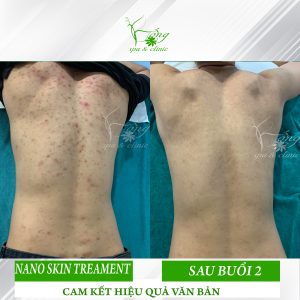 Spa Trị Mụn Lưng Uy Tín TPHCM