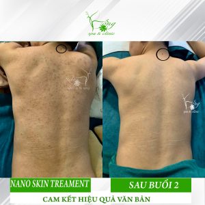 Spa Trị Mụn Lưng Uy Tín TPHCM