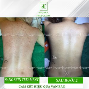 Spa Trị Mụn Lưng Uy Tín TPHCM
